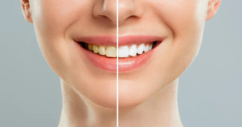 En kvindes tænder før og efter tandblegning (tandblegning).