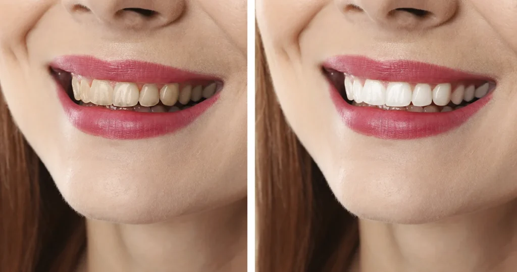 En kvinde med gule tænder før og efter en tandblegningsbehandling.