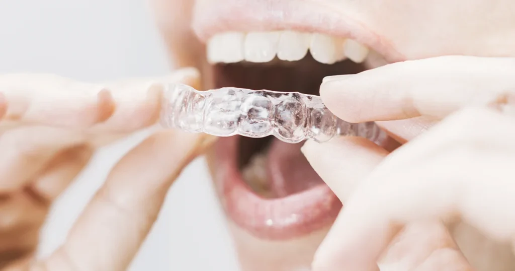 En kvinde har en klar aligner i munden til tandregulering.