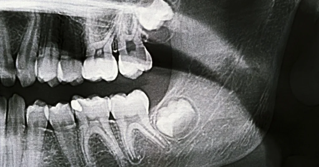 Røntgenbillede af en visdomstand i underkæben